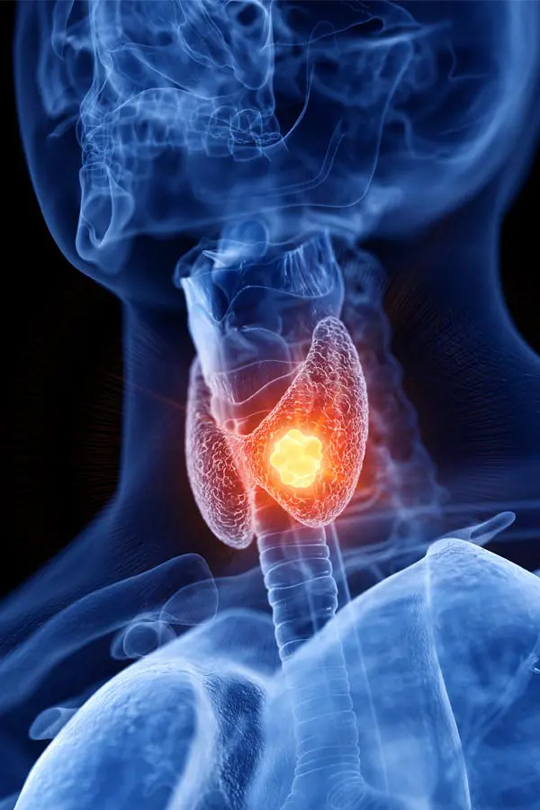 Thyroid-Imbalance-Treatment A 3D illustration of an x-ray of a human neck, highlighting the thyroid. Get help with thyroid imbalance from Better Life Carolinas of Mount Pleasant in Charleston Metro.